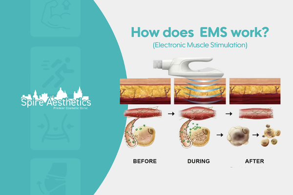 EMS treatment for post pregnancy weight loss treatment South Side