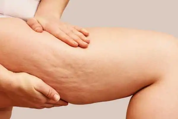 Image of woman showing leg with cellulite South Side