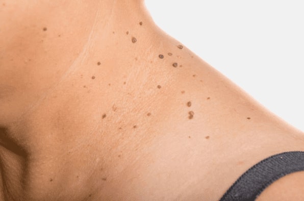 Are you looking for easy skin tag removal South Side - then contact Spire today!