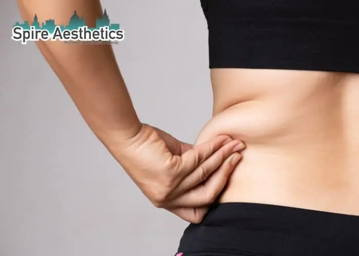 Image of woman pinching fat on their hips South Side. Fat Freezing treatment