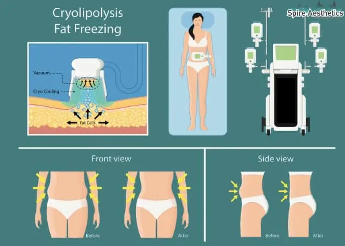 Fat freezing treatment South Side benefits for competitions to remove stubborn fat deposits.