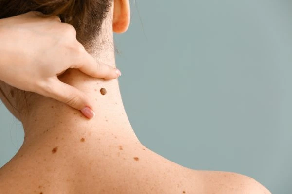 skin blemish removal South Side treatment
